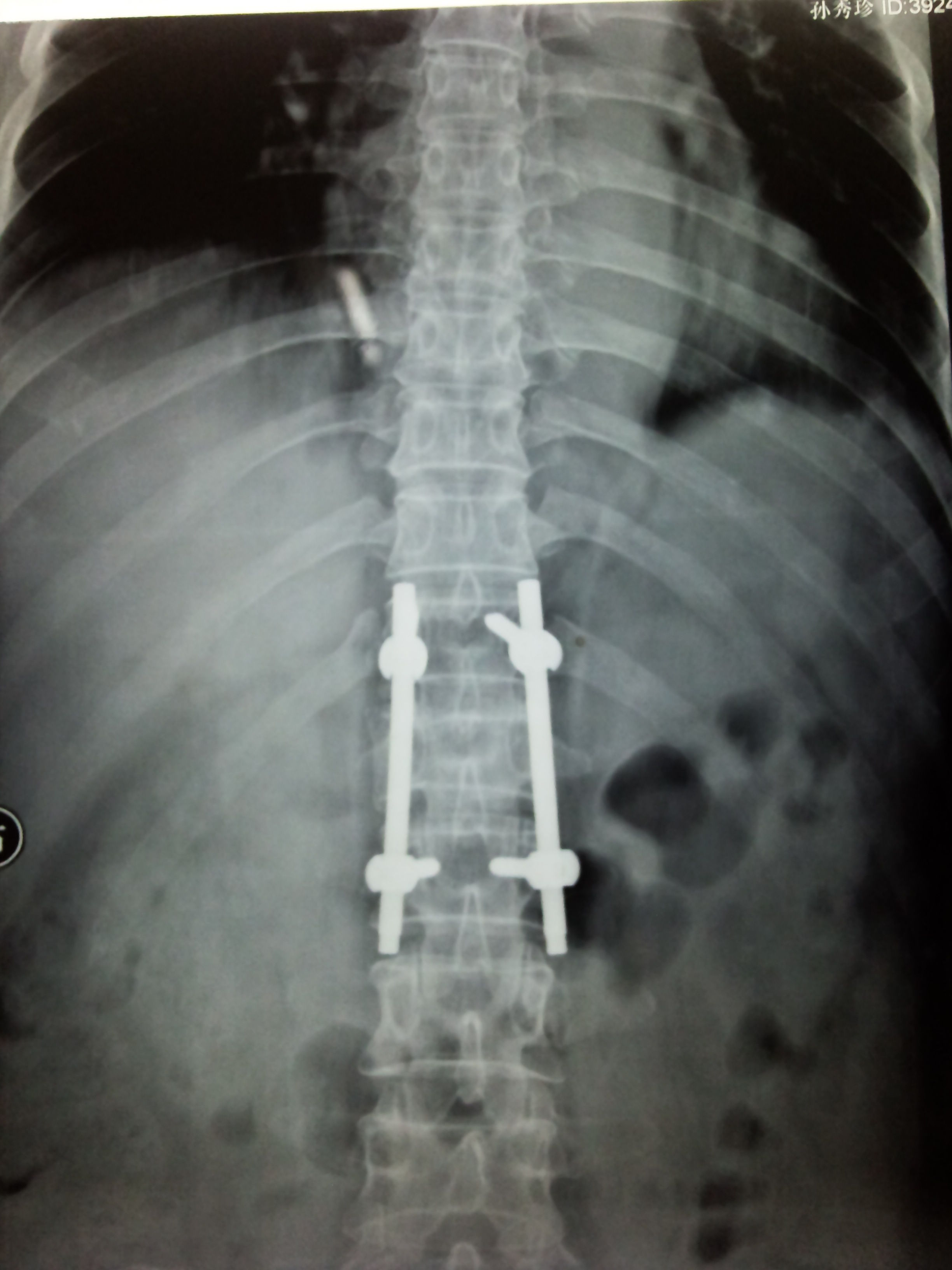 胸腰椎椎弓根螺钉 - REED Polyaxial Reduction Screw - H.P.I. Medical - 多轴 / 金属