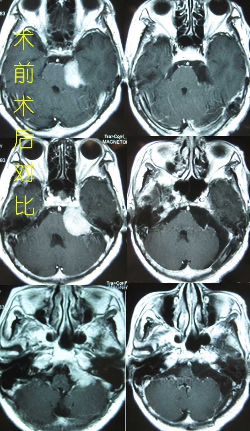 警惕致命的颅内良性肿瘤——岩斜区脑膜瘤
