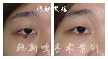 眼睑黑痣的手术治疗前后对比--韩新鸣手术案例 - 好大夫在线