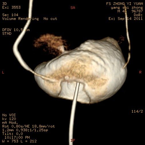ct三维成像诊断膀胱破裂1例  (二)