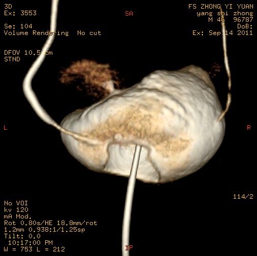 膀胱损伤是泌尿外科常见急症,多因外伤所致.膀胱损伤可分成三类