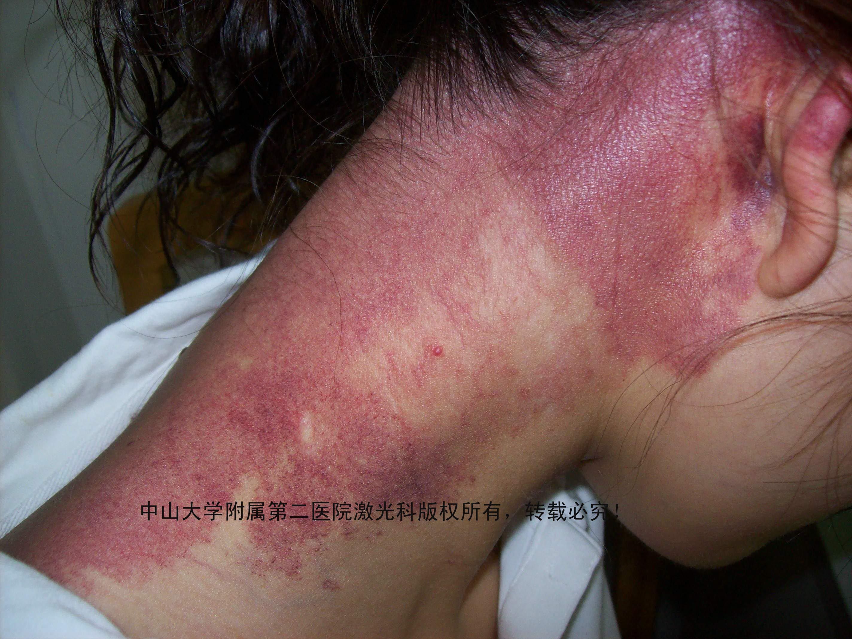 中山大学附属第二医院激光科治疗鲜红斑痣的效果图