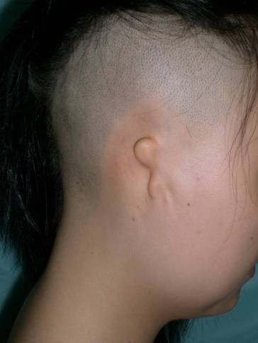 小耳畸形分度照片 - 好大夫在线