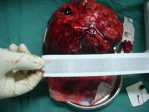 照片巨大右肺上沟癌切除