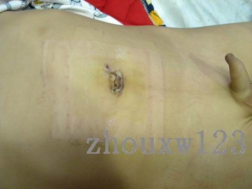 粪石性肠梗阻(单孔腹腔镜小肠切开取石)