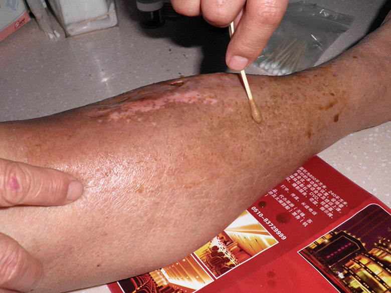 臁疮腿治疗图片