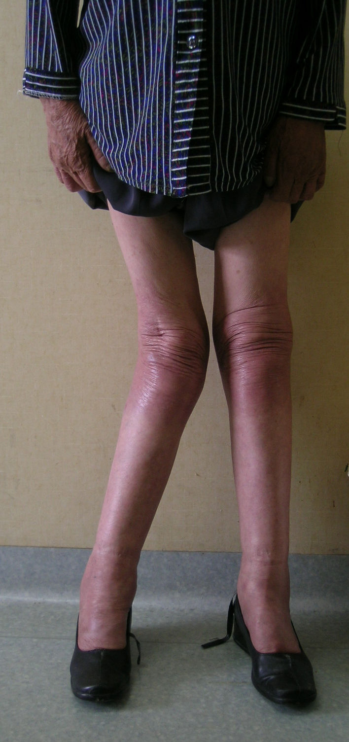 高难度手术之六:严重膝关节反屈畸形