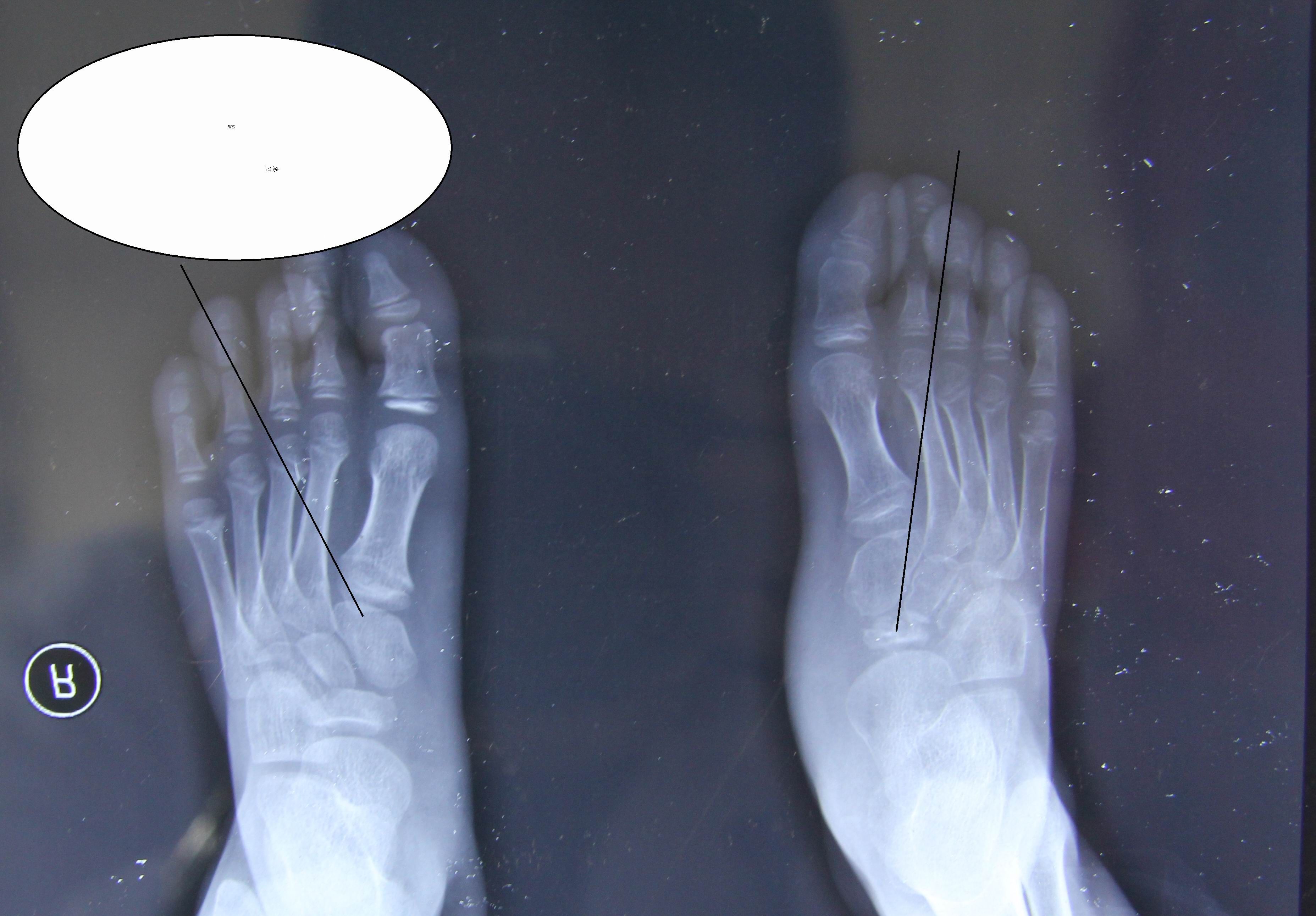 左脚舟状骨位置图图片