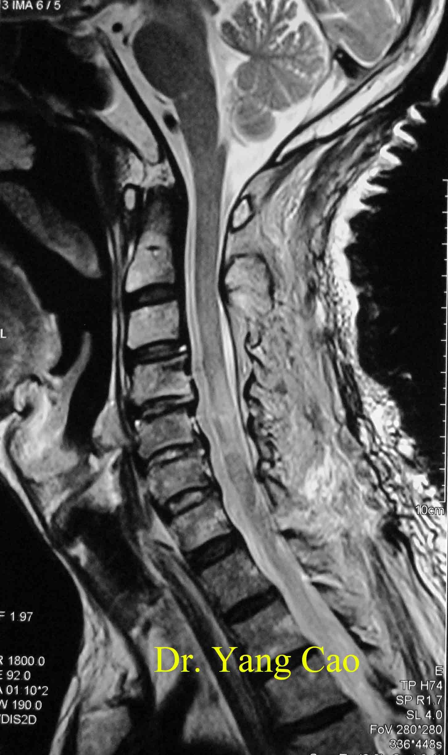 正常脊椎侧面图,正常和不正常脊椎图片,正常颈椎侧面图_大山谷图库