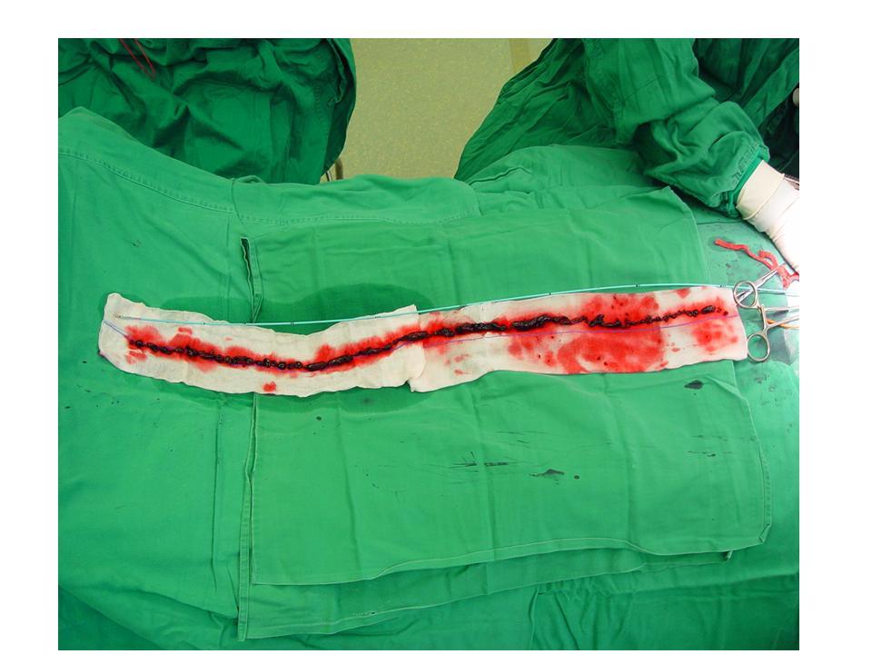 急性下肢动脉栓塞的典型表现