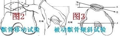 ①髌骨移动试验(图2:正常情况下髌骨可以被向内侧推移达髌骨1/4的