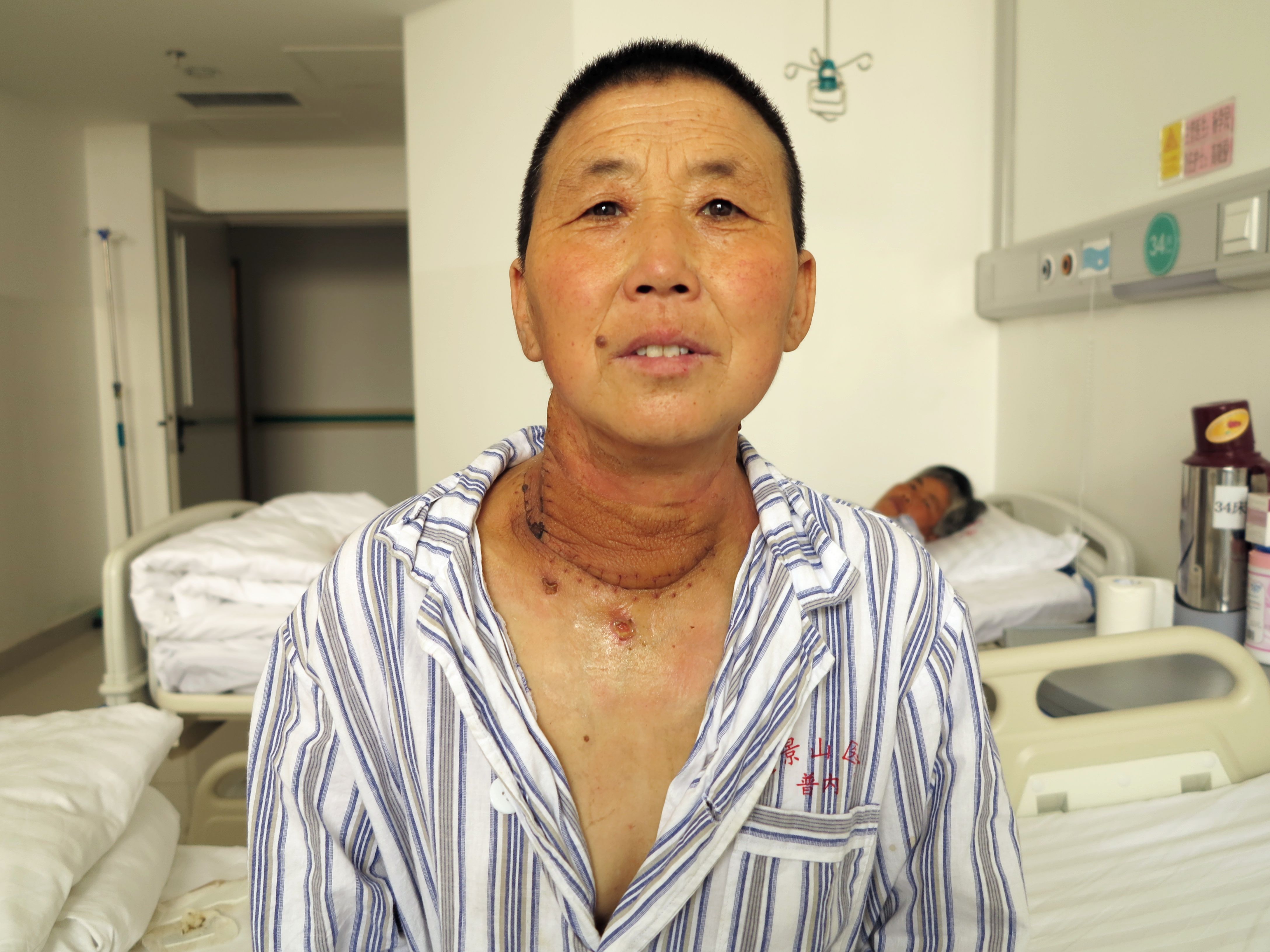 普外科成功施行巨大甲状腺癌切除及颈淋巴清扫术