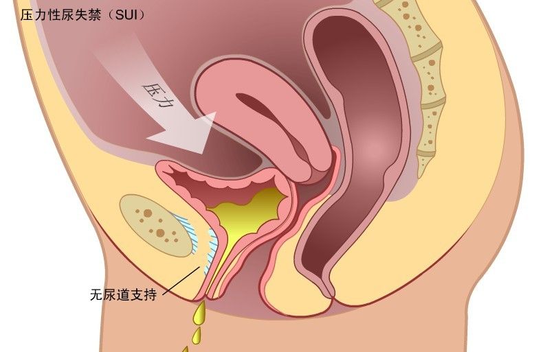 女性排尿困难的治疗 女子严重尿潴留排尿困难 原是巨大子宫肌瘤作祟