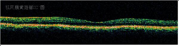 眼科oct设备简介