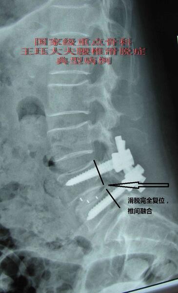 病例9女62歲一例特殊Ⅱ度腰椎滑脫合併腰椎管狹窄症病例椎板延長