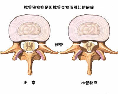 狭窄 腰椎 脊柱 症 管