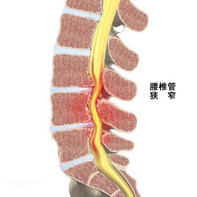 腰椎管包括中央椎管和侧方椎管,前者主要指硬膜囊占据的部分,后者为