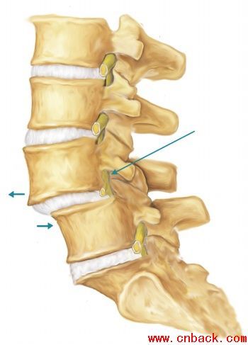 腰椎滑脫問答
