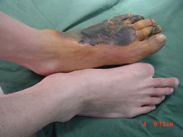 动脉缺血导致患者足部坏死