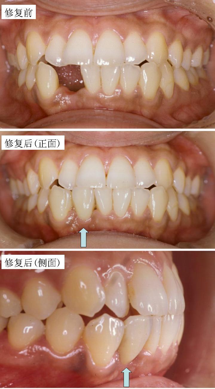 牙齿固定桥修复图片图片