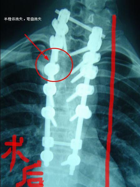 上图:手术后:通过截骨切除半椎体,钉棒系统矫形固定,侧弯获得完全矫正