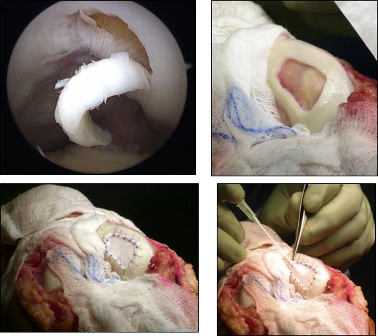 使周围形成一个由正常软骨组织形成的垂直边缘;清除钙化软骨层,不