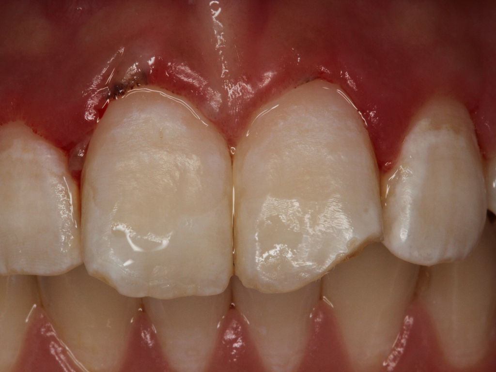 牙齿脱矿症状和图片图片