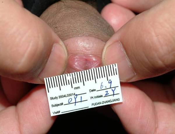 艾拉光动力治疗尖锐湿疣照片给大家展示一下