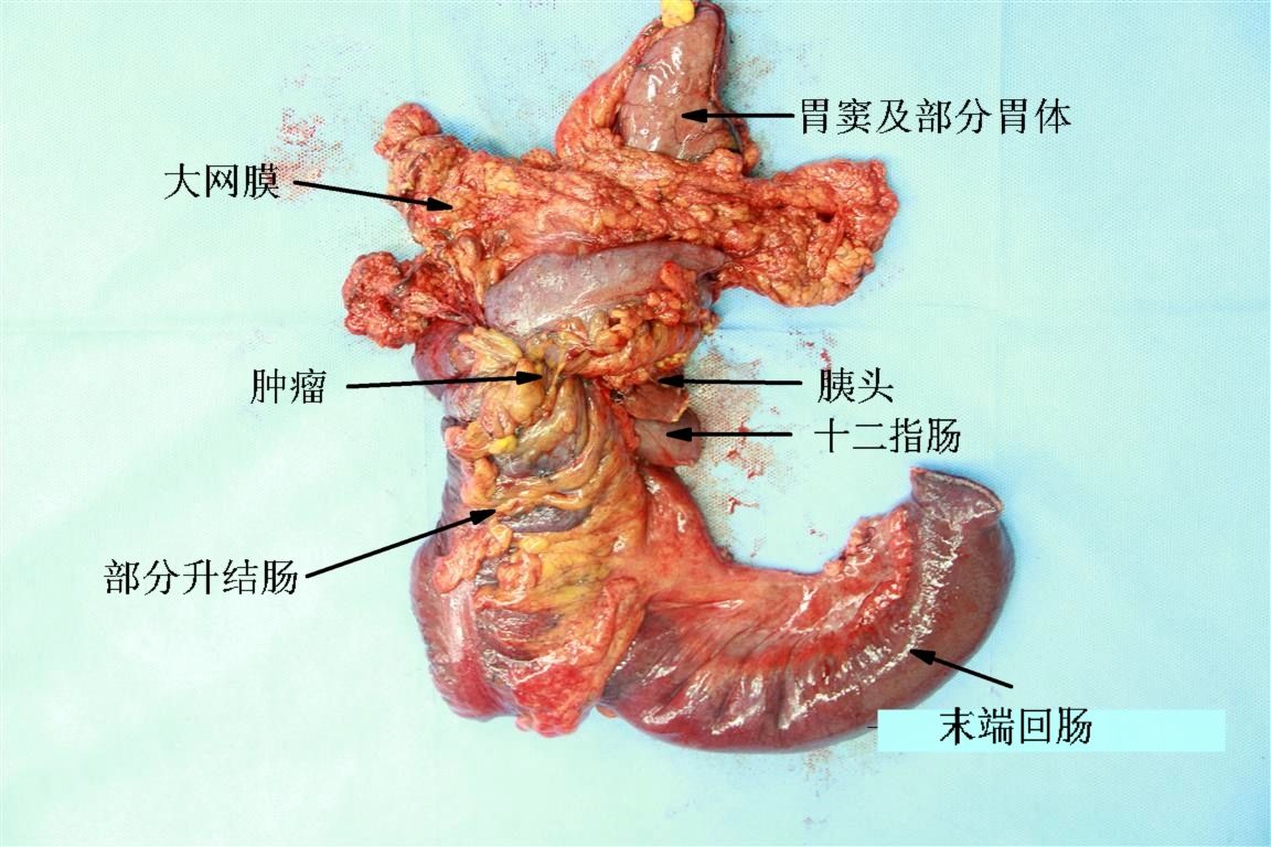 右半结肠癌联合胰十二指肠切除病例报道 - 好大夫在线