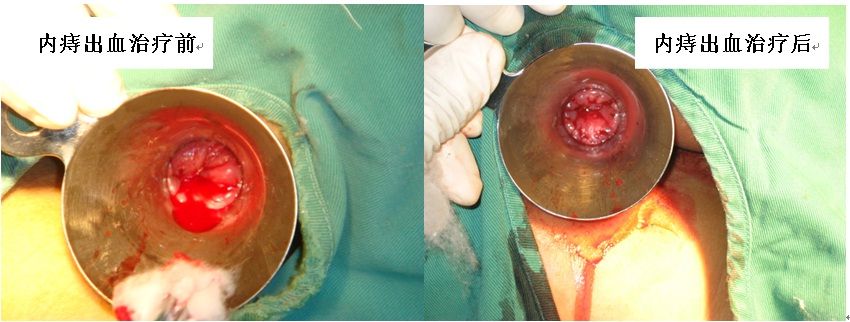 痔瘡微創治療銅離子電化學治療技術
