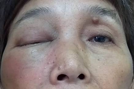 鼻窦炎并发眼眶的感染(图) - 好大夫在线