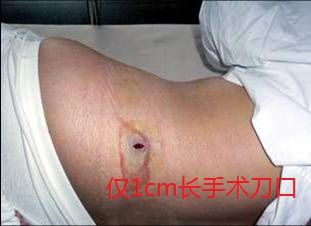 腰椎间盘突出症患者的最佳治疗方案