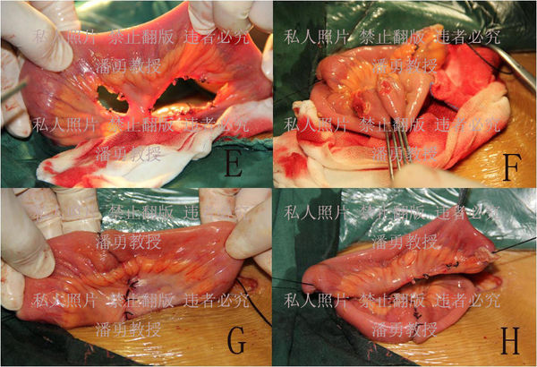 易性病男变女变性或先天性无阴道的阴道再造新法