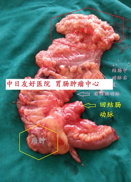 微創結腸癌行腹腔鏡右半結腸切除術四孔法術後如期出院