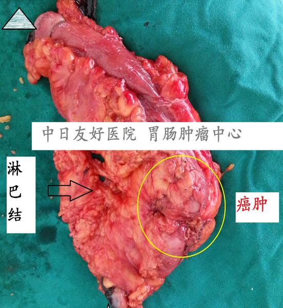 微創:腹腔鏡左半結腸切除,結腸黑變病併發結腸癌