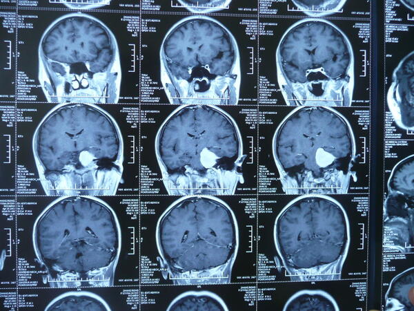 左桥小脑角脑膜瘤手术切除