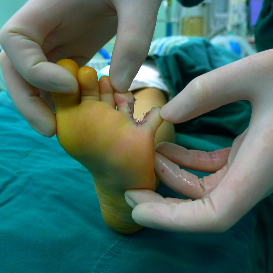 右2,3完全性并趾,早期双翼皮瓣成形指蹼,未植皮,术后1年,指蹼足趾正常