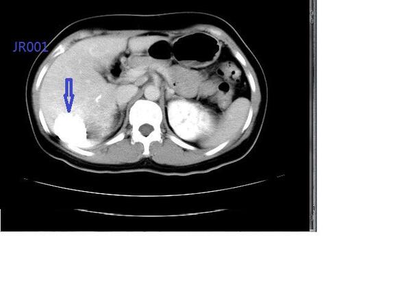 肝脏海绵状血管瘤--微创介入治疗