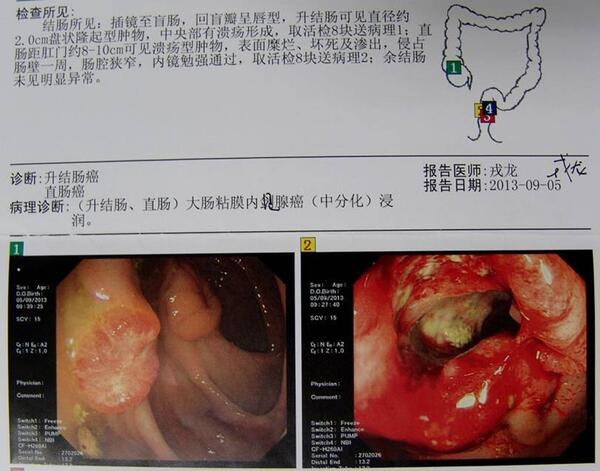 右半結腸吻合口及直腸低位吻合口圖4 升結腸癌,直腸癌及膽囊結石的