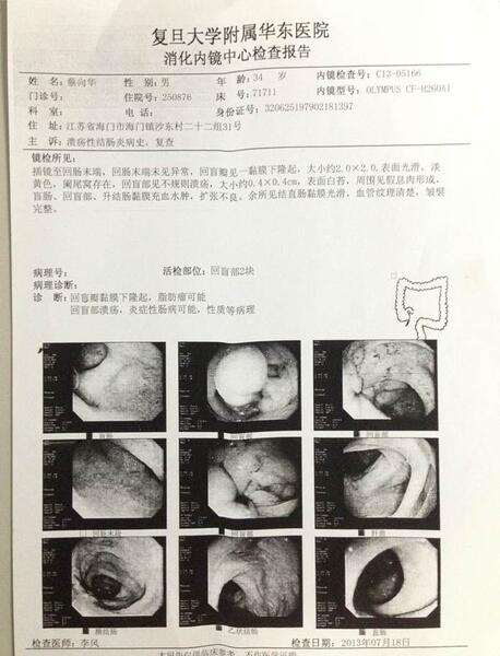 腸內營養對克羅恩病病情有良好的治療作用,這是治療前的腸鏡報告