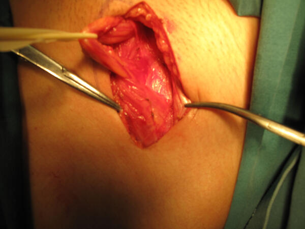 切除睾丸手术全过程图片