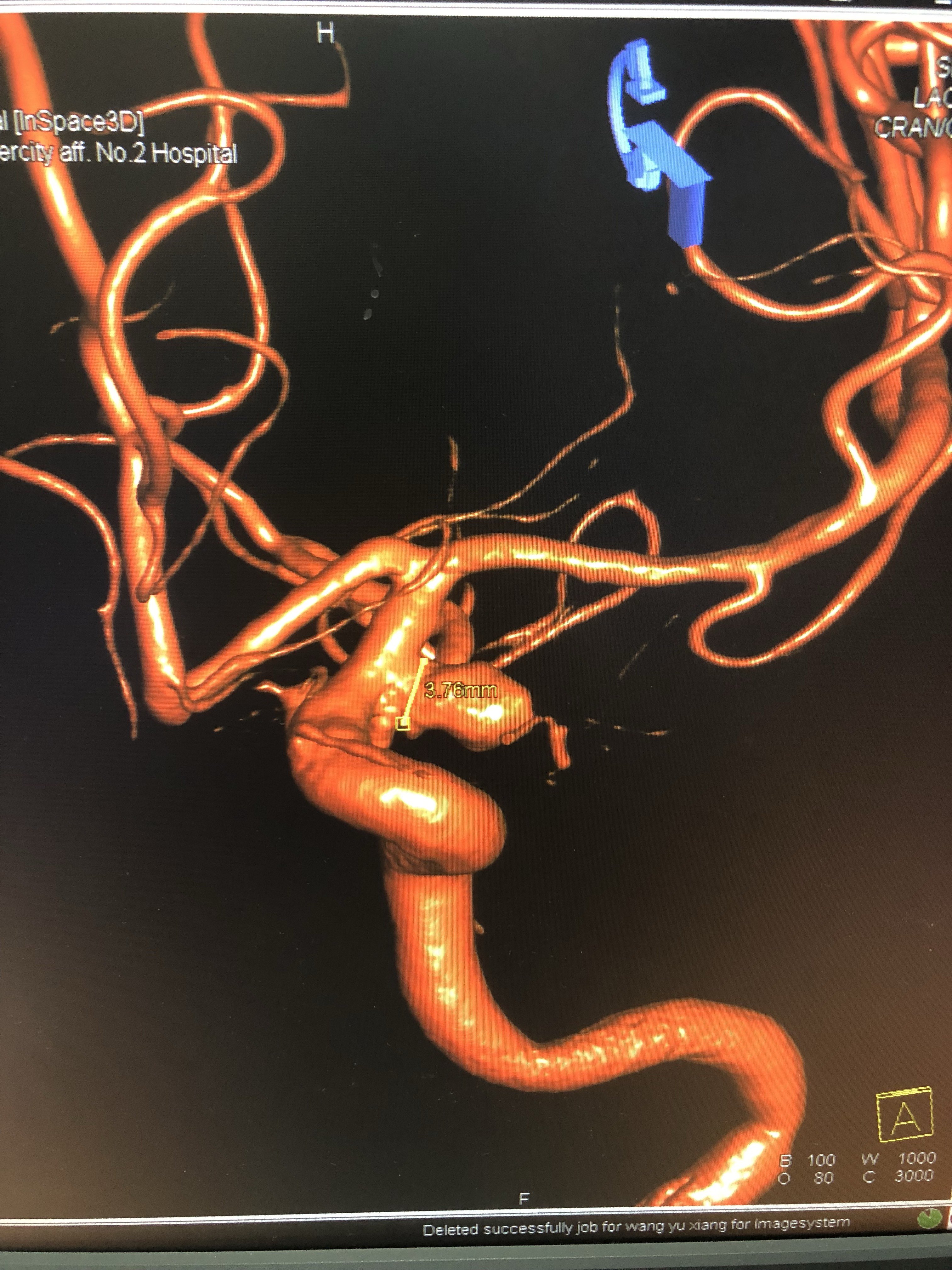 20180421后交通动脉瘤一例