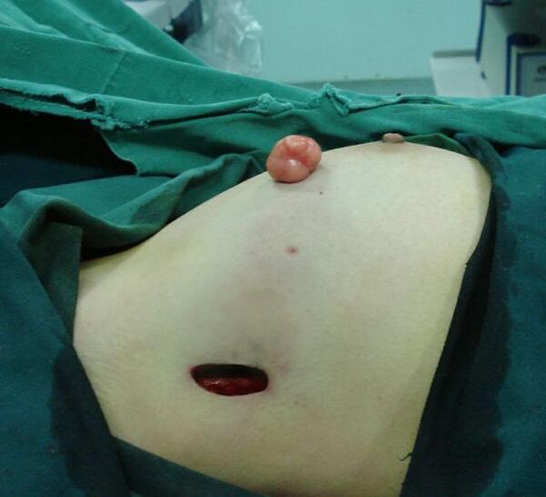 乳房切除术 割掉图片