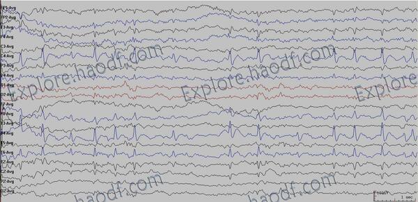 儿童良性癫脑电图图片