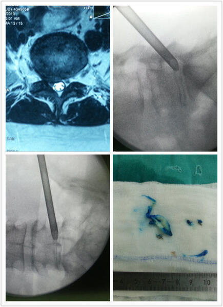 一例微創椎間孔鏡治療腰五骶一椎間盤突出手術