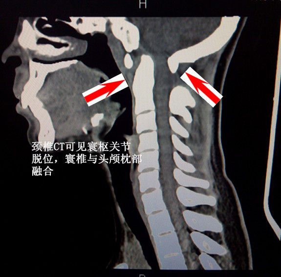 術前頸椎ct