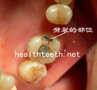 牙槽嵴裂图片