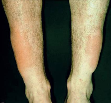 甲亢的特殊症状_甲亢_症状_症状表现 - 好大夫在线