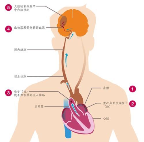 心房颤动(房颤)主要的危险是什么?