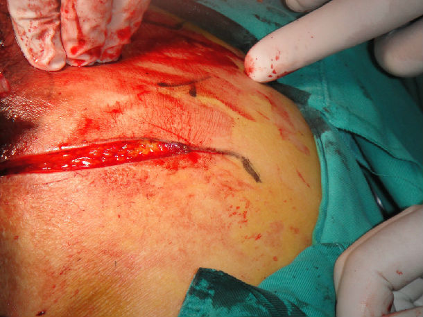 我县首例骶尾部顽固溃疡———局部切除加转移性皮瓣术 